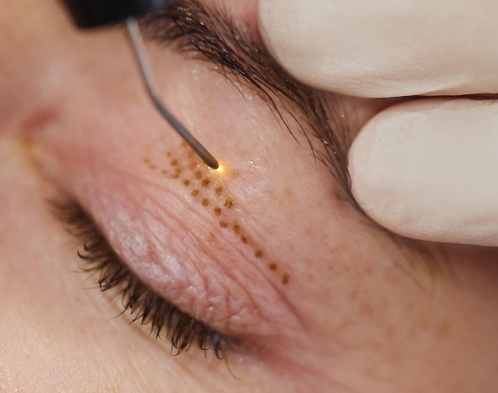 Platelet-Rich-Pen Platelet Rich Pen